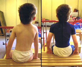 Brace Treatment in Neurological Scoliosis